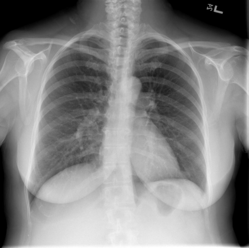 Xray Chest PA and Lateral | Open-i