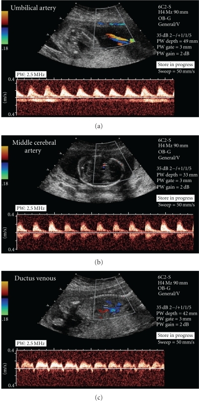 doppler-velocimetry-of-fetal-vessels-a-depicts-a-nor-open-i