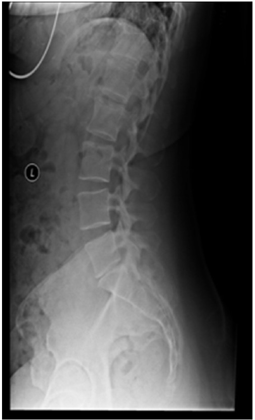 A lumbar radiograph with narrowing of the L5–S1 disc | Open-i