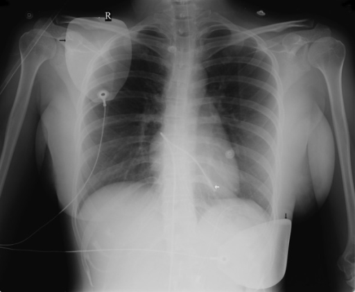 Chest X-ray showing external pacing pads (black arrows) | Open-i