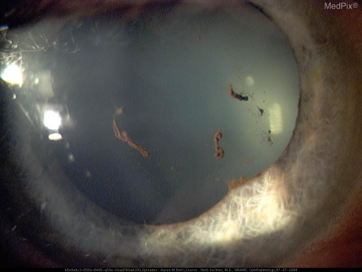 This image shows the pigment on the anterior lens capsu | Open-i