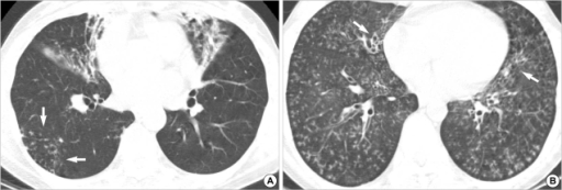 Typical radiographic presentations of the nodular bronc | Open-i