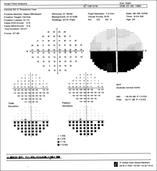 case-1-a-30-2-humphrey-s-visual-field-analysis-of-the-right-eye-shows-an-inferior-altitudinal