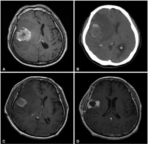 A: Preoperative MRI revealed a metastatic brain tumor a | Open-i