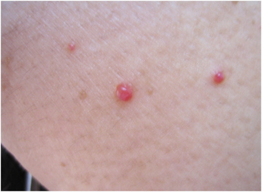 multiple-eruptive-cherry-red-papules-on-the-neck-open-i