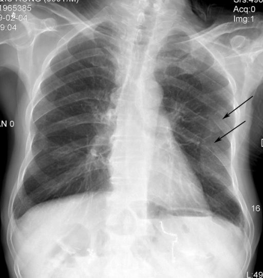 X-ray image. A chest radiograph showed fractures of the | Open-i