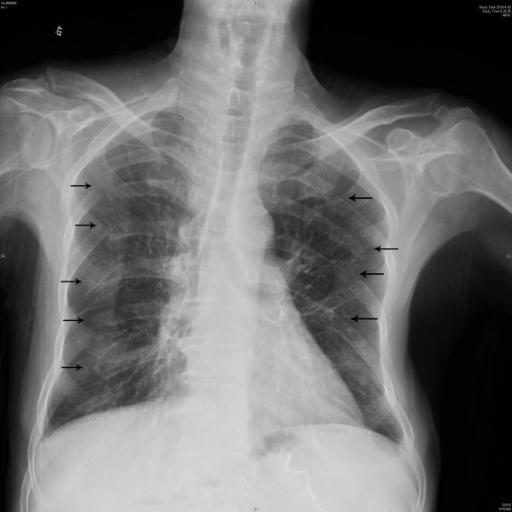 X-ray Image. A Chest Radiograph Showed Multiple Fractur 