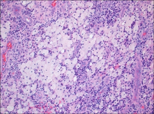 Xanthogranulomatous inflammation, including foamy histi | Open-i