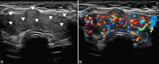 multinodular-goiter-transverse-gray-scale-ultrasound-open-i