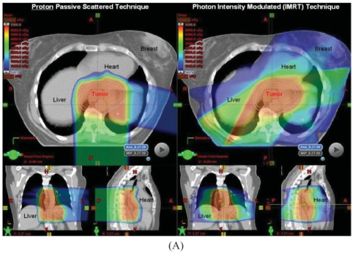 Comparison plans of IMRT and Passive Scattering Proton | Open-i