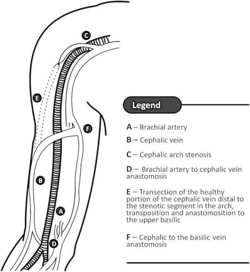 illustration of the cephalic vein transposition techniq open i