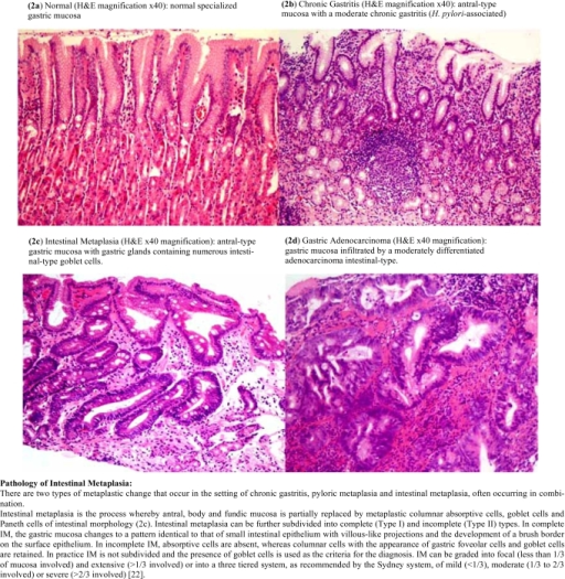 H&E Stained Histopathology Sections Of A) Normal Ga | Open-i