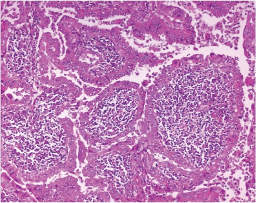 Histological examination of tumor showing the typical f | Open-i