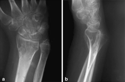 Radiographs of DRUJ dislocation. a Anteroposterior (AP) | Open-i