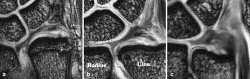 Ulnar variance. a Positive, b neutral, c negative ulnar | Open-i