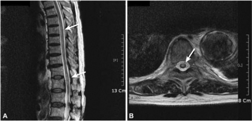 Magnetic Resonance Imaging (MRI) Scan Showing Spinal Co | Open-i