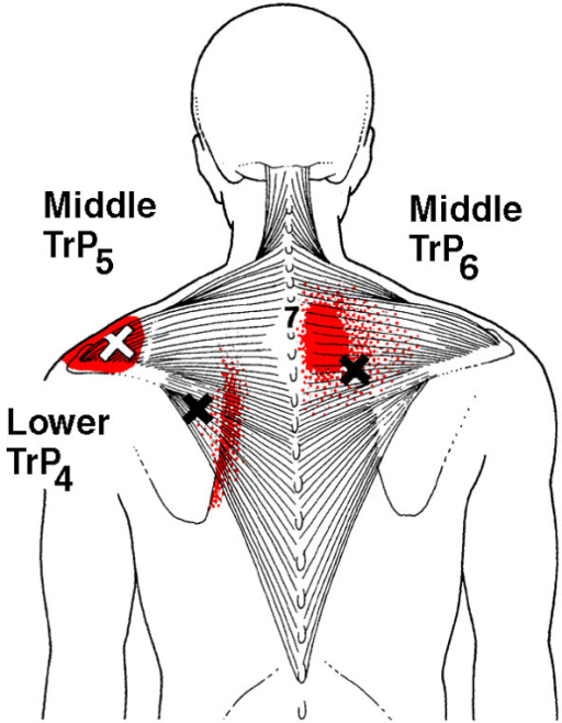 Referred pain patterns (red) from the upper and middle | Open-i