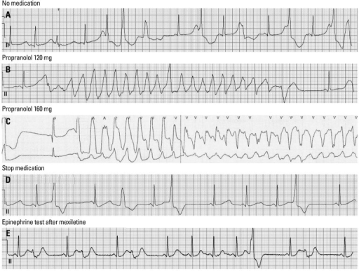 The ECG documented events during epinephrine provocatio | Open-i