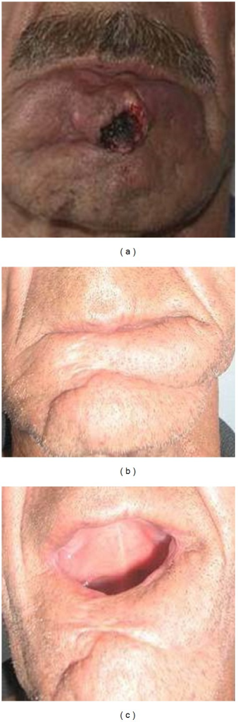 a Frontal view of patient with lower lip squamous cel Open i