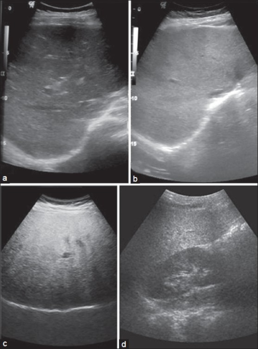 grades-of-fatty-liver-on-visual-analysis-ultrasound-im-open-i