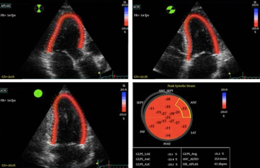 Left Ventricular Global Longitudinal Strain (GLS) In A | Open-i