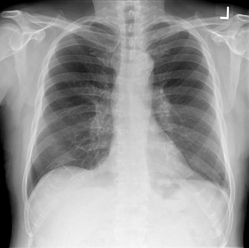 Pa And Lateral Chest X Ray