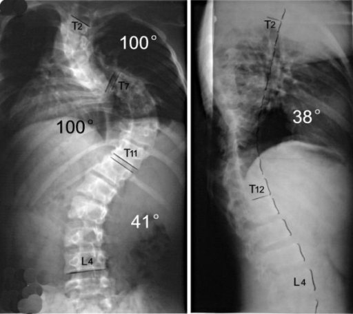 M,12Y, neurofibromatosis scoliosis, double thoracic cur | Open-i