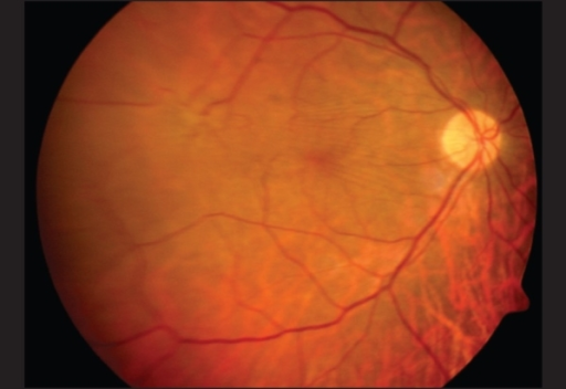 Fundus Photograph Showing The Epiretinal Membrane Seen After First Surgery Fundus Photograph Showing The Epiretinal Membrane Seen After First Surgery