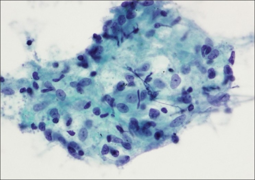 A lymph node aspirate reveals a cluster of epithelioid | Open-i