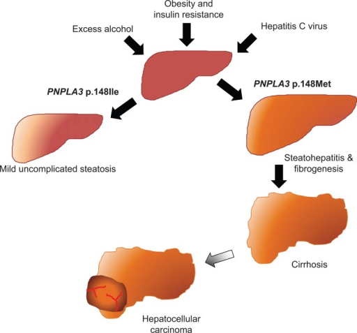 The I148M PNPLA3 mutation and progressive liver disease | Open-i