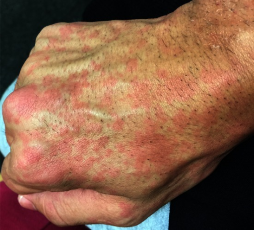 Typical evanescent rash Multiple nonpruritic confluen Openi