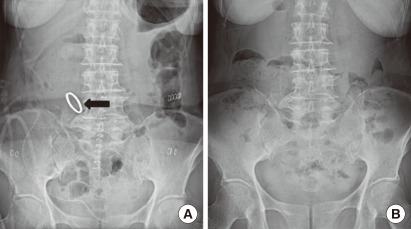 Plain abdominal radiographs after Hand CAC 30 anastomos | Open-i