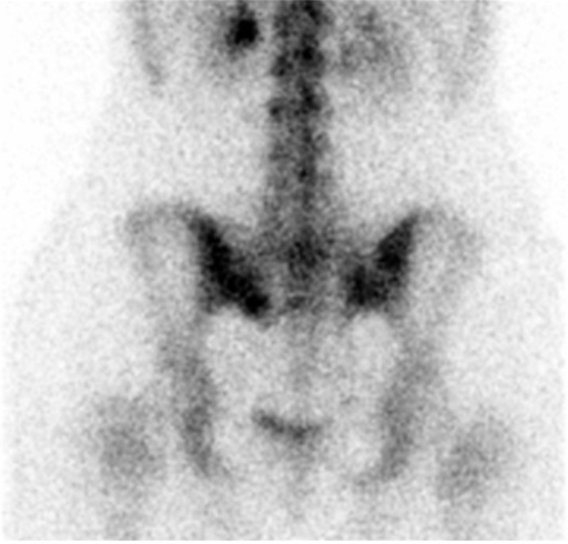 Technetium 99m (Tc-99m) bone scan showing increased upt | Open-i