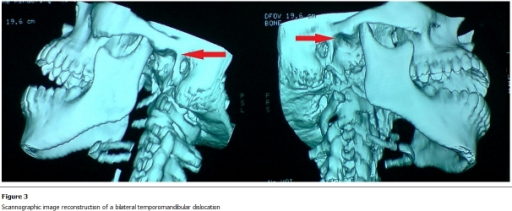 Articulación Temporomandibular Articulación Temporomandibular ATM