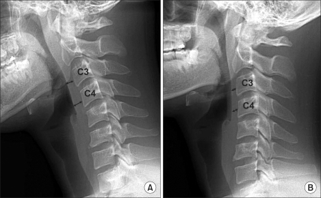 (A) Initial lateral cervical spine radiograph shows inc | Open-i