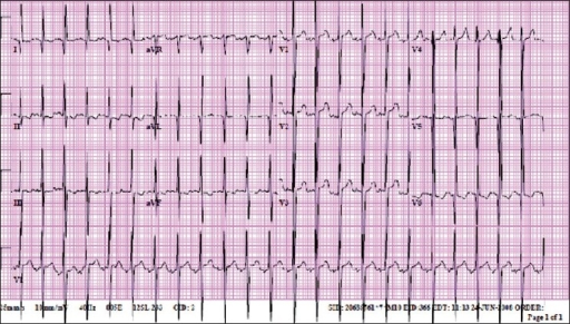 EKG of an eight-month-old who initially presented to th | Open-i