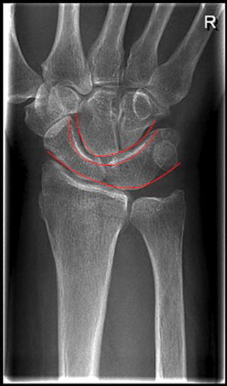 Thearcs of Gilula drawn on another patient’s X-ray wi | Open-i