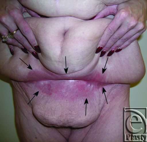 Surgical Management of the Giant Pannus: Indications, Strategies