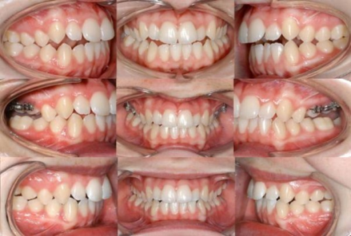 cirurgia mordida abierta