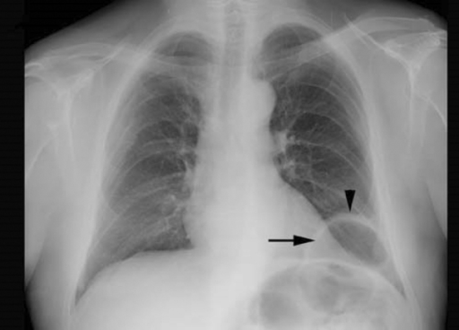 69-year-old man with chronic diaphragmatic hernia. PA c | Open-i