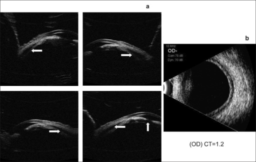 Ultrasound biomicroscopy (a) Right Eye showing 360° ci | Open-i