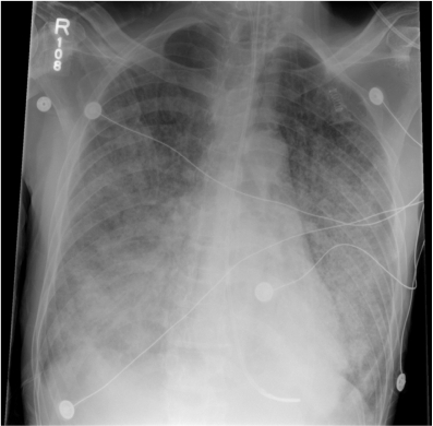 Chest radiograph showing bilateral diffuse interstitial | Open-i