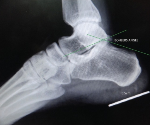 X-ray of the ankle in lateral view shows Bohler's angle | Open-i