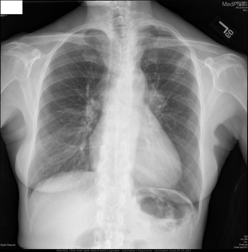 Left Upper Lobe Opacification And Mediastinal Widening 