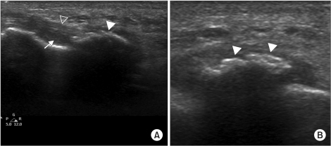 Longitudinal ultrasonography view shows tenosynovitis ( | Open-i