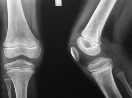 Normal Pediatric Knee X Ray