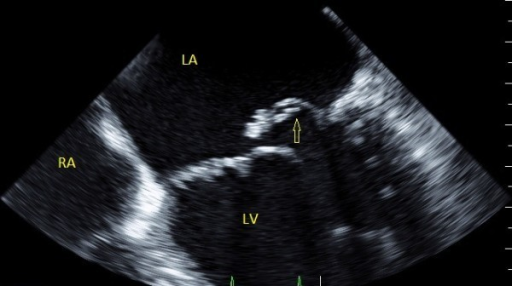 TEE showing the flail Posterior Mitral Leaflet (P2), wi | Open-i