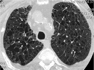 Centrilobular emphysema. HRCT shows centrilobular areas | Open-i