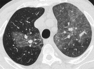 Mosaic Pattern Radiology Assistant | image gallery mosaic attenuation Mosaic Pattern Radiology Assistant | image gallery mosaic attenuation
