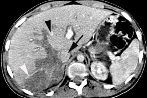 Abdominal CT. Degree Ⅳ liver laceration. White arrowh | Open-i